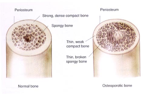 Hueso sano y afectado por osteoporosis. La transmutación del silicio en calcio y su posterior asimilación, jugarían un papel clave.
